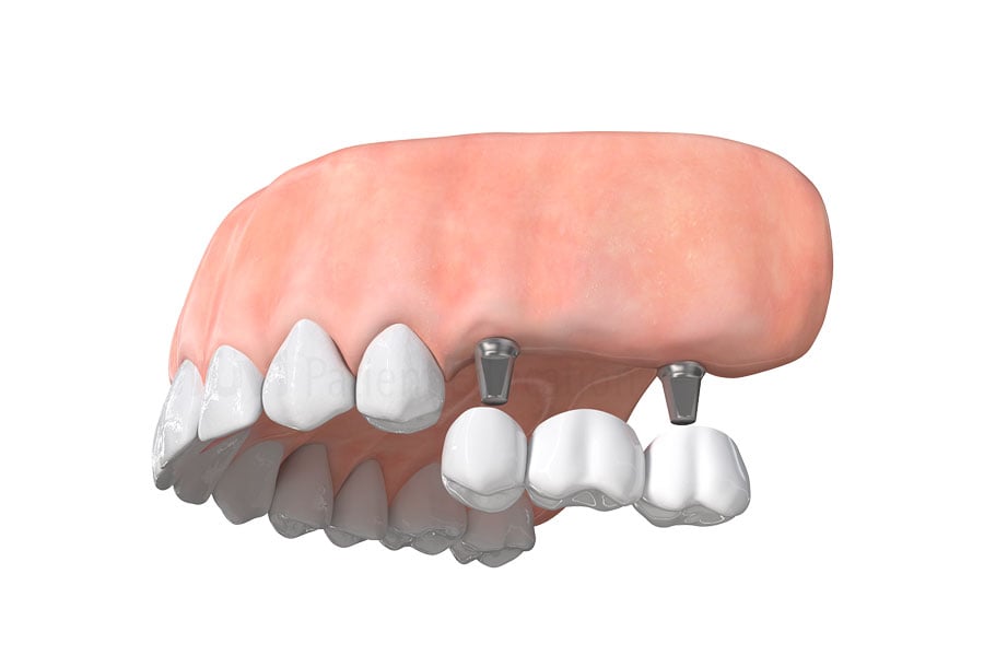 Implant-Supported Bridge