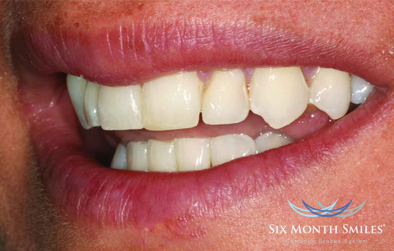 Arlington Dental Associates before and after transformations in Arlington Heights, IL. Before & After Dental Transformations in Arlington Heights, IL.
