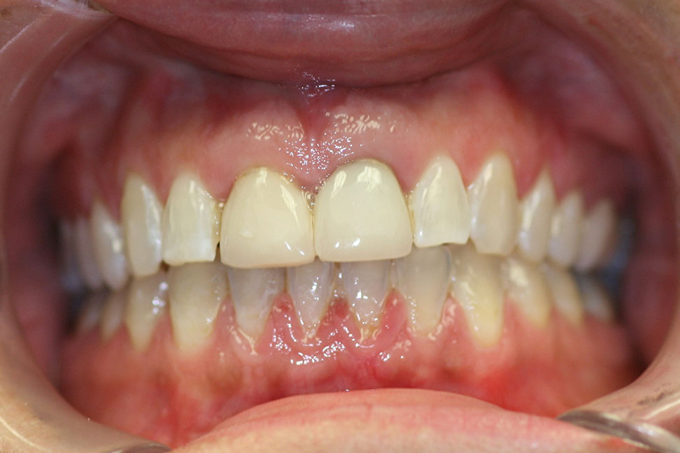 Arlington Dental Associates before and after dental transformations in Arlington Heights, IL. Before & After Dental Transformations